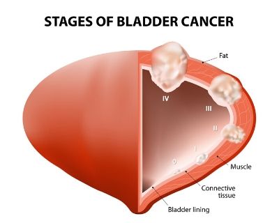 6 Symptoms Of Bladder Cancer Photos